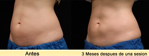 Criolipolisis opiniones